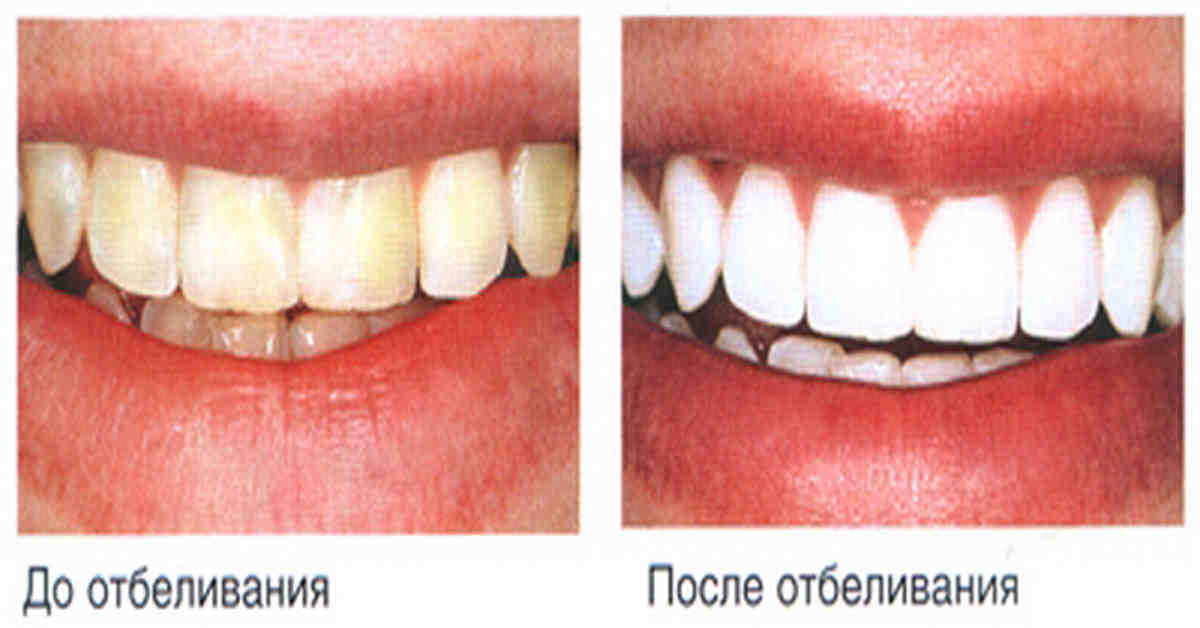 Диета После Отбеливания Зубов Сколько Дней