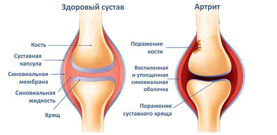 Изображение - Лечение суставов содой stroenie-sustava-pri-artrite