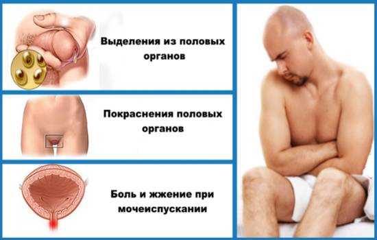 мужская молочница симптомы